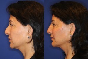 before and after image of woman who has had a non-surgical rhinoplasty 4