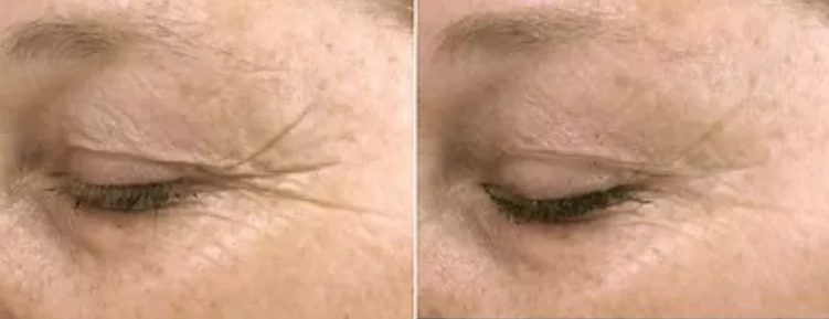 Exosome Therapy Treatment in NYC for Aging Skin - Before After Results