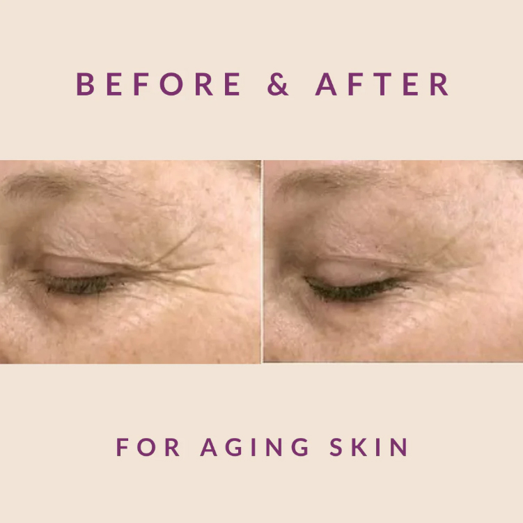 Exosome Therapy Treatment in NYC for Aging Skin - Before After Results