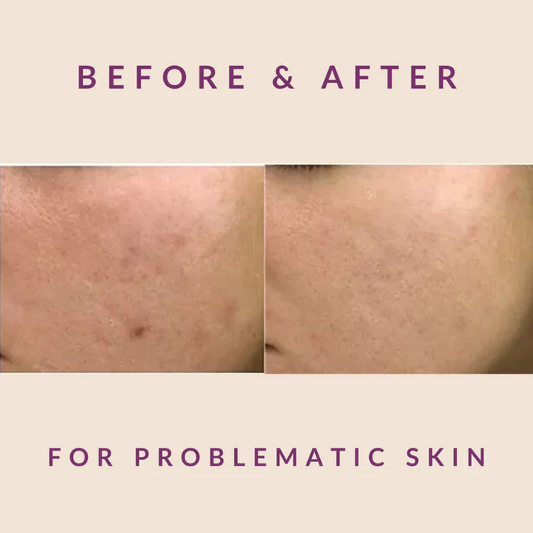 Exosome Therapy Treatment for Problematic Skin - Before After Results