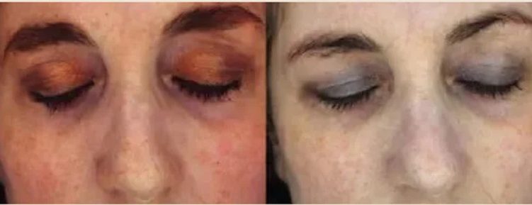 Exosome Therapy for Rensitive Skin - Before After Results