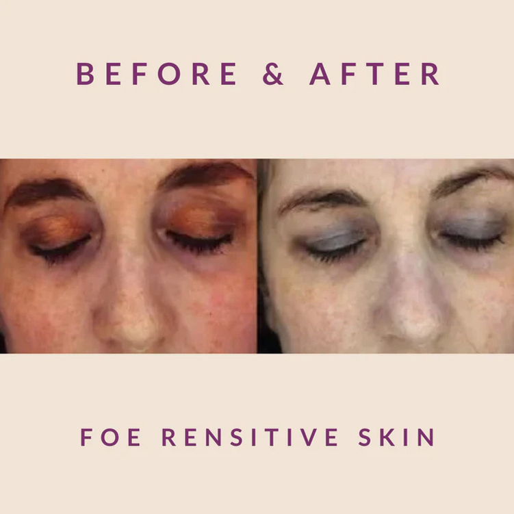 Exosome Therapy for Rensitive Skin - Before After Results