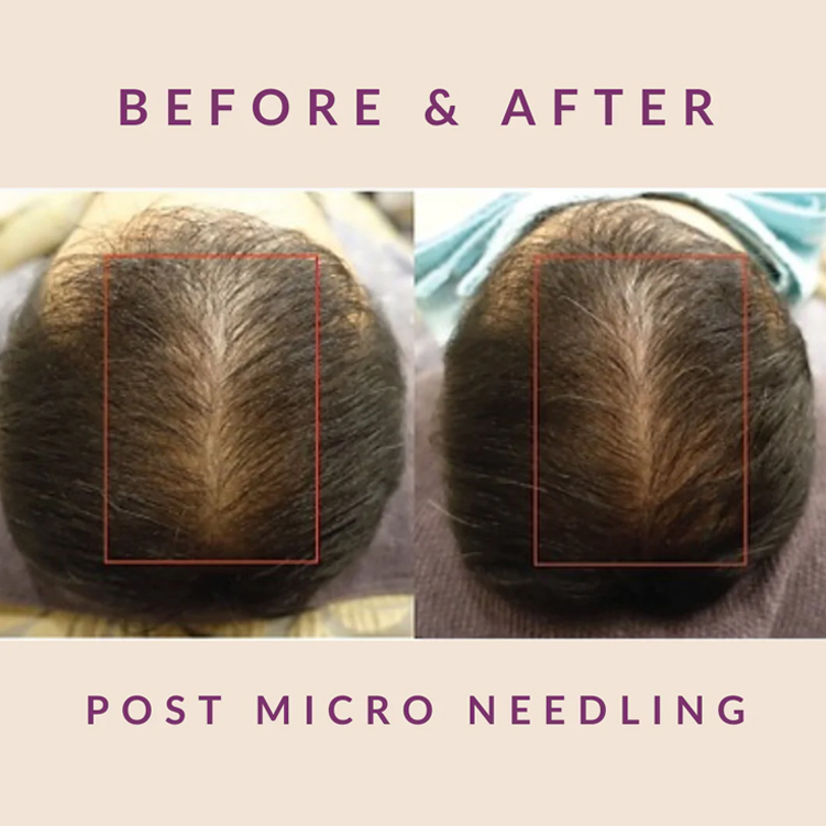 Before After Results of Post Micro Needling with Exosome Therapy Treatment