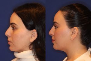 before and after image of woman who has had a non-surgical rhinoplasty 3