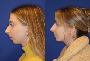 before and after image of woman who has had a non-surgical rhinoplasty 2