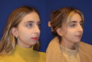 before and after image of woman who has had a non-surgical rhinoplasty