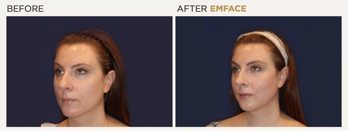 Before After Results of EMFACE in NYC