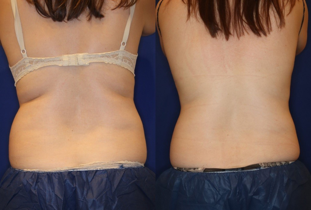 Body Sculpting and Body Contouring Treatment in New York