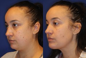 buccal fat removal before and after