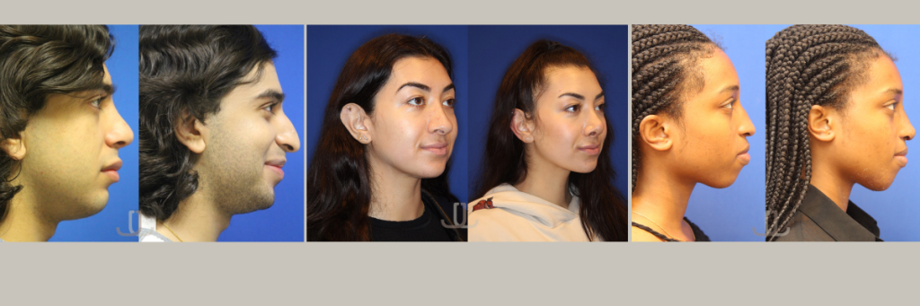 surgical rhinoplasty before and after nyc dr. Jennifer Levine