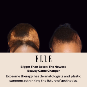 Before and after comparison of hair restoration using exosome therapy, as featured in ELLE magazine.