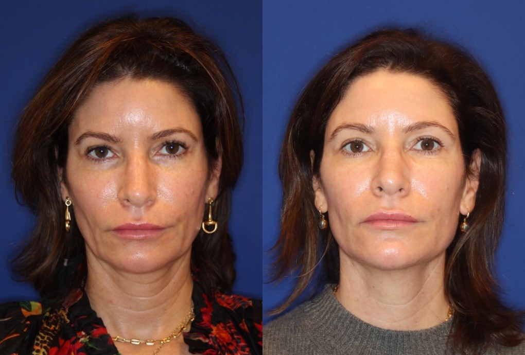 Dermal fillers for facial balancing - lips, cheeks, and chin before and after