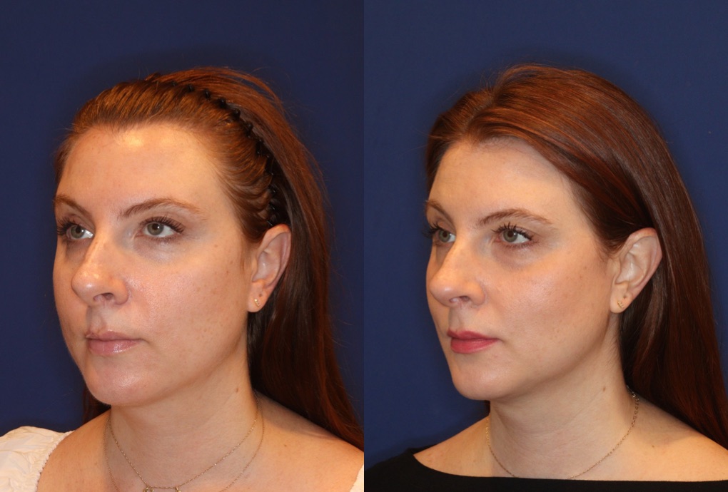 Emface treatment results - facial contouring and lifting in NYC