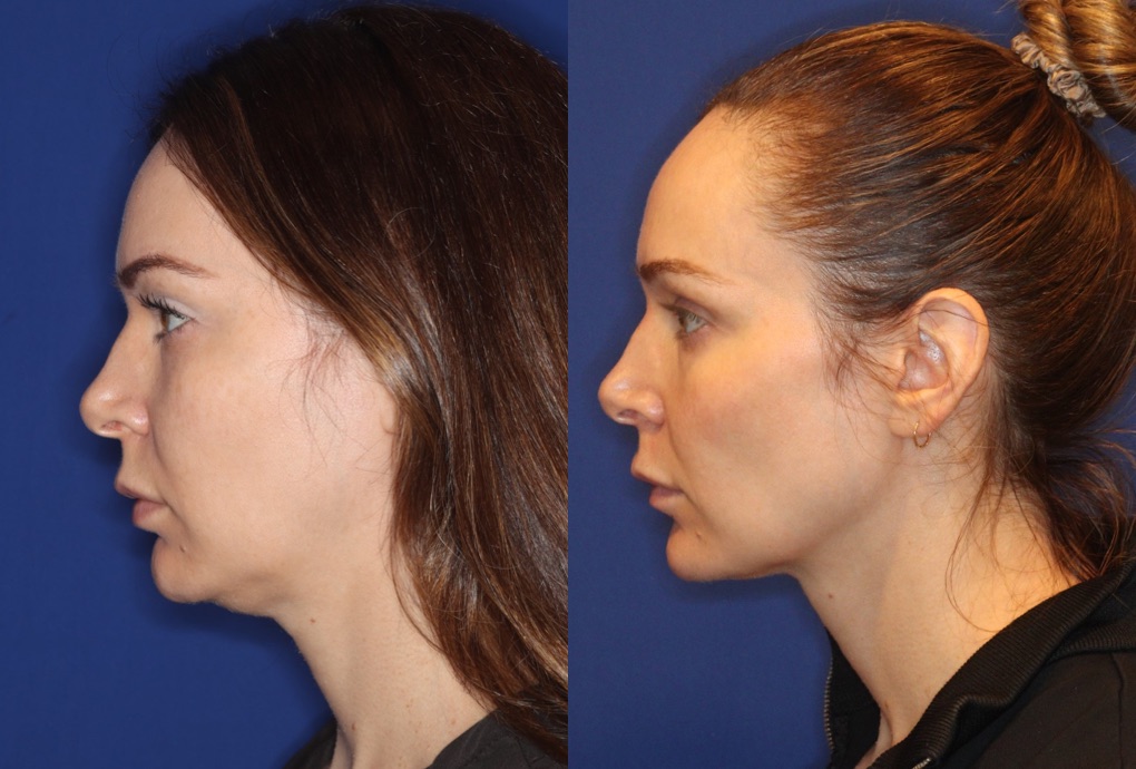 Before and after photo of patient's face facing to the left after full EMFACE Submentum treatment with submental applicator. After photo shows improved jawline contouring and double chin fat reduction as well as improved cheek contouring. Photo is against blue background with even lighting.