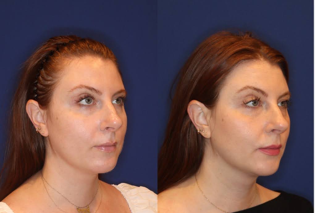 Pre and post-treatment side-by-side images of a female patient, highlighting the facial contouring and skin tightening effects of EMFACE for Double Chin Fat Reduction treatment.