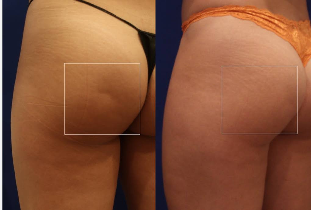 "Close-up comparison of a client's buttock area showing significant improvement in skin texture and reduction of cellulite post-treatment."
