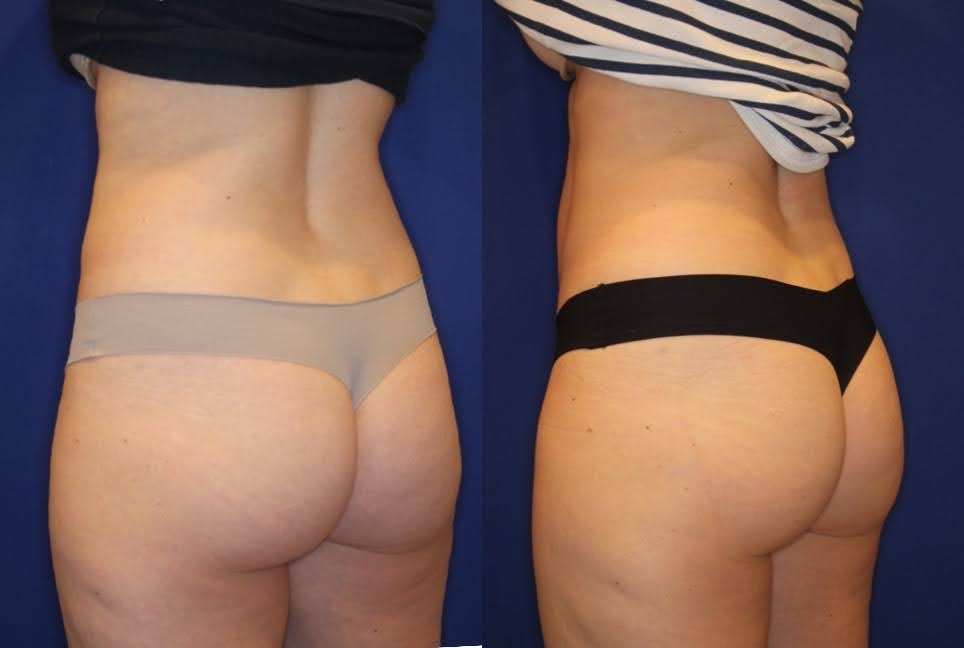 "Before and after comparison of a nonsurgical butt lift treatment showing a notable enhancement in shape and reduction of hip dips."

