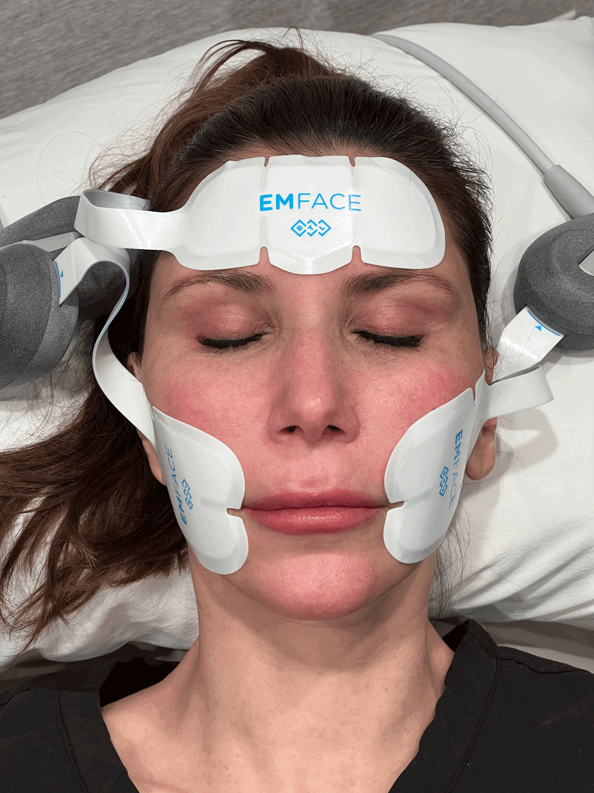 A female patient receiving Emface treatment, with facial electrodes in place, demonstrating the non-invasive procedure for facial toning and lifting.