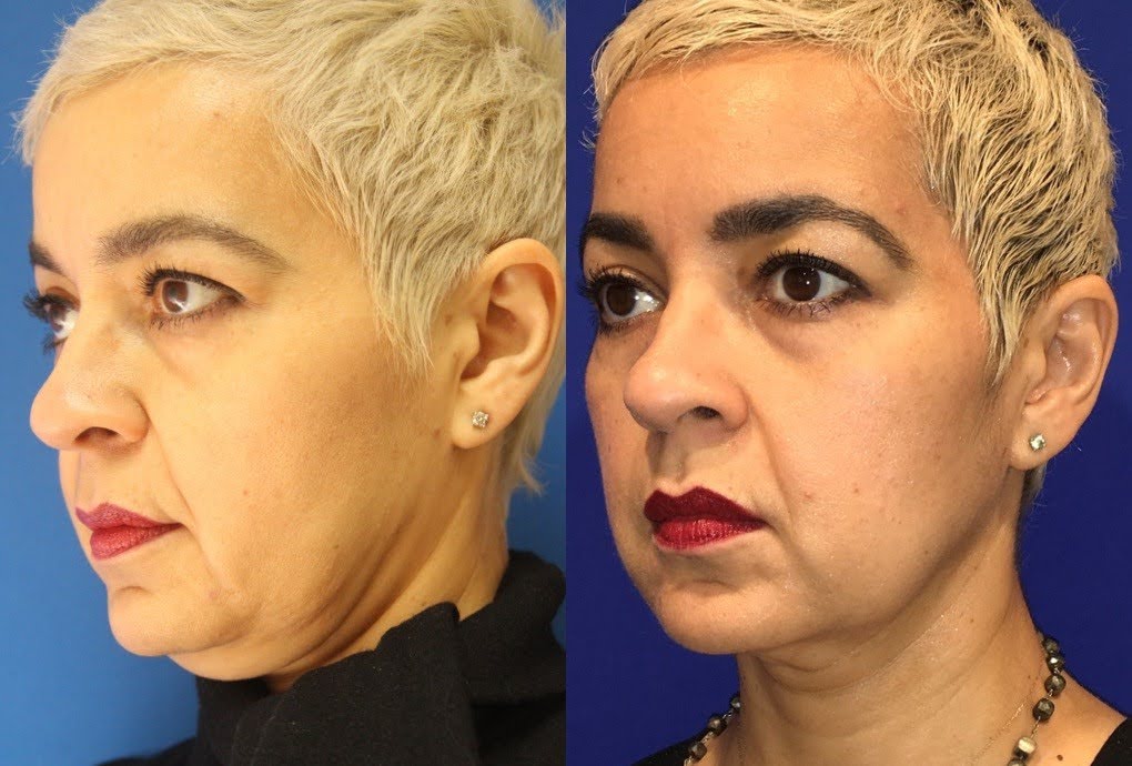 Pre and post-treatment comparison of a woman's profile undergoing an ultrasound facelift, with noticeable improvements in skin tone and texture.