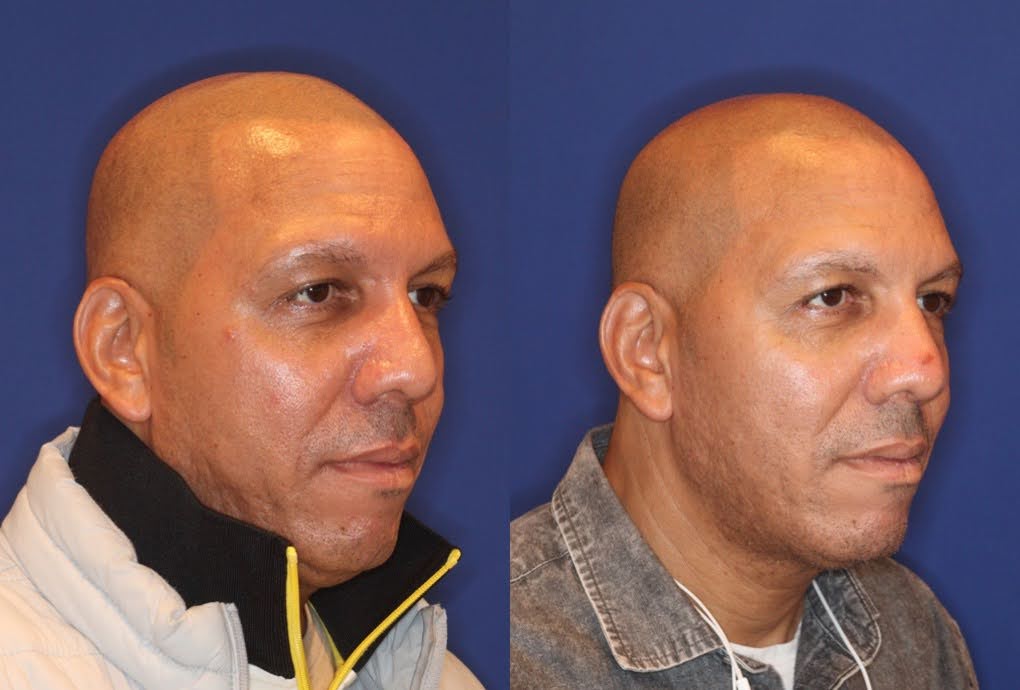 Before and after shots of a man's profile view, demonstrating the effectiveness of ultrasound facelift treatment in reducing signs of aging.