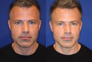 Before and after comparison of a male patient's face undergoing ultrasound facelift treatment, showcasing visibly tighter skin post-procedure.