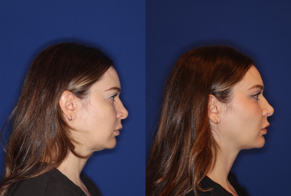 Before and after comparison of a female who did Emface treatment in NYC, showcasing impressive double chin reduction and neck contouring without surgery, with no visible bruising or needles, evidencing a smoother, more defined neck profile against a blue backdrop.