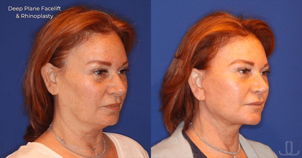 nyc facelift before and after photo of a female patient who also had a rhinoplasty