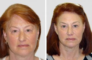 blepharoplasty bna