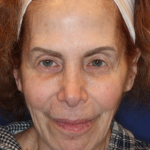 Facelift / Neck Lift Before & After Patient #15094