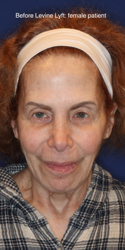Facelift / Neck Lift Before & After Patient #15094