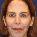Facelift / Neck Lift Before & After Patient #15094