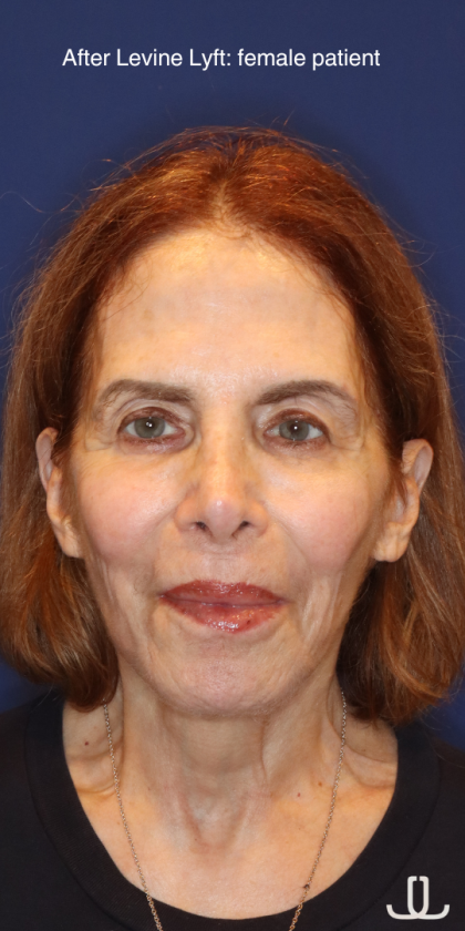Facelift / Neck Lift Before & After Patient #15094