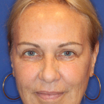 Facelift / Neck Lift Before & After Patient #15100