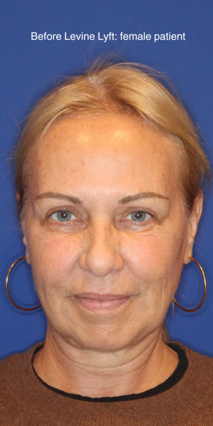 Facelift / Neck Lift Before & After Patient #15100