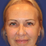Facelift / Neck Lift Before & After Patient #15100