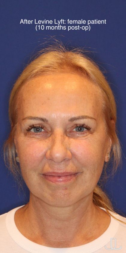 Facelift / Neck Lift Before & After Patient #15100