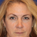 Liquid Facelift Before & After Patient #15788