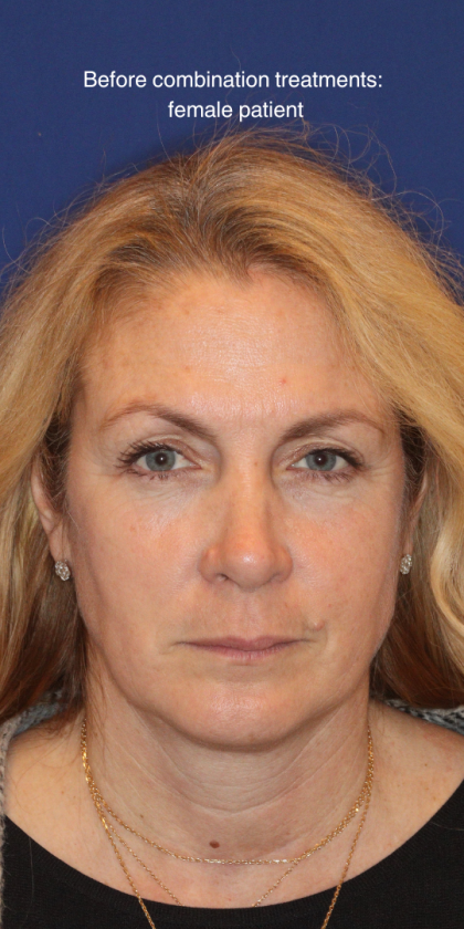Liquid Facelift Before & After Patient #15788