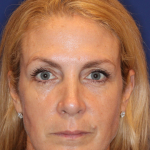 Liquid Facelift Before & After Patient #15788