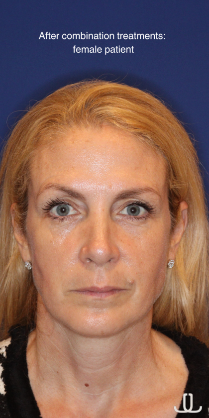 Liquid Facelift Before & After Patient #15788