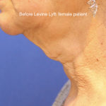 Facelift / Neck Lift Before & After Patient #15749