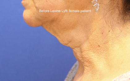 Facelift / Neck Lift Before & After Patient #15749