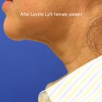 Facelift / Neck Lift Before & After Patient #15749