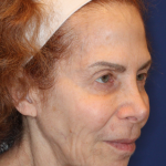 Facelift / Neck Lift Before & After Patient #15094
