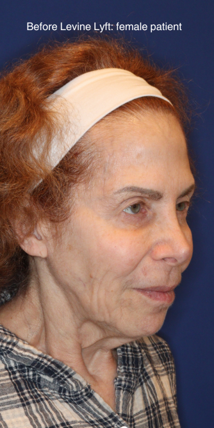 Facelift / Neck Lift Before & After Patient #15094