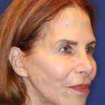 Facelift / Neck Lift Before & After Patient #15094