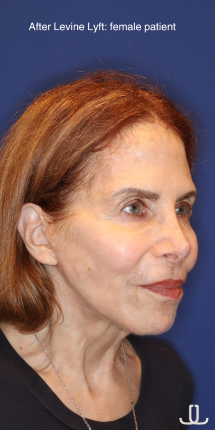 Facelift / Neck Lift Before & After Patient #15094