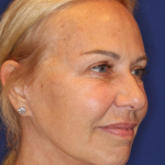 Facelift / Neck Lift Before & After Patient #15100