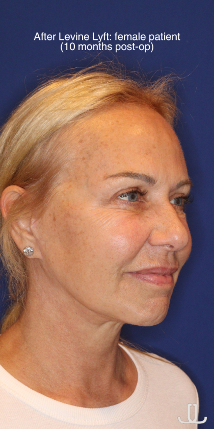 Facelift / Neck Lift Before & After Patient #15100