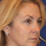 Liquid Facelift Before & After Patient #15788